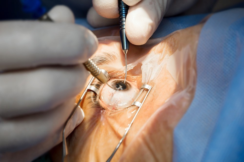 Cataract Phaco Surgery