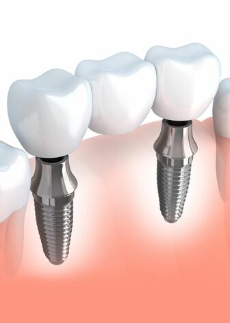 Implant